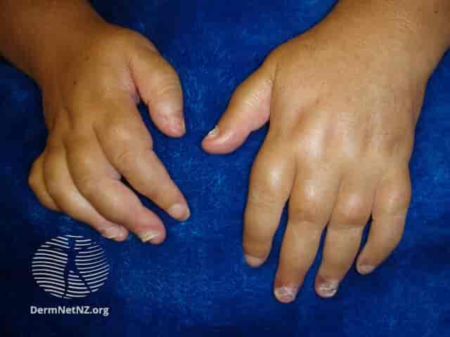 Hevelse i fingrene ved psoriasisartritt med daktylitt