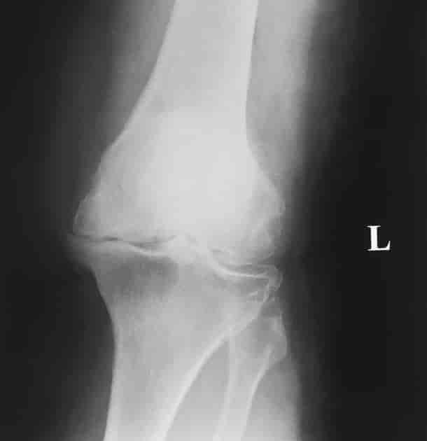 Alvorlig artrose i ett kneledd. Røntgenbildet viser lav leddspalte og osteofytter.