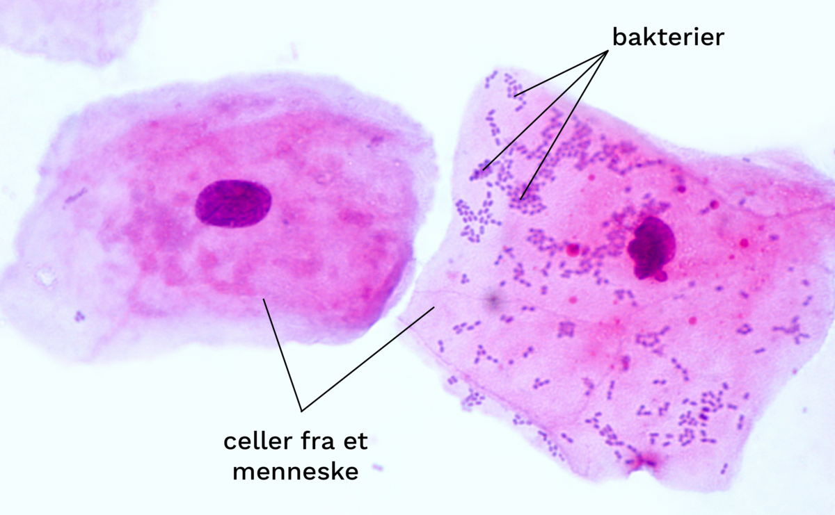 Mikroskopifoto av en prøve fra innsiden av kinnet. Menneskecellene ser ut som lilla speilegg, hvor cellekjernen er plommen. Bakteriene er mørkelilla prikker som har klistret seg til den ene cellen.
