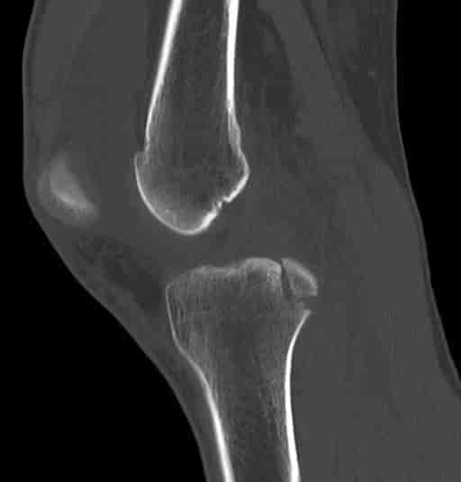 CT-bilde viser hemartros i kneledd etter sparkesykkelulykke med bruddskade på leggbenet mot kneleddet. 