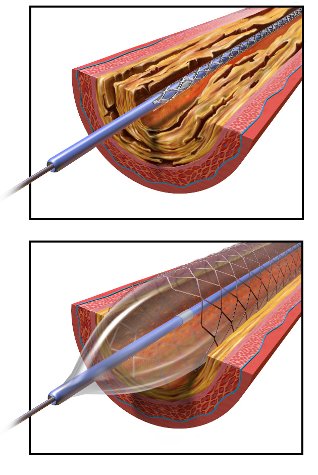 Angioplastikk med stent