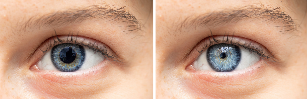 To nærbilder av et øye med blå øyenfarge. I det første bildet er pupillen stor og utvidet, den blå øyenfargen er en smal sirkel rundt pupillen. I det andre bildet er pupillen liten og sammentrukket, og man ser mer av øyenfargen.