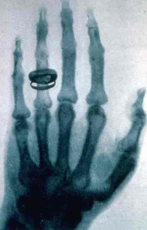 Røntgenbilde av en menneskehånd.