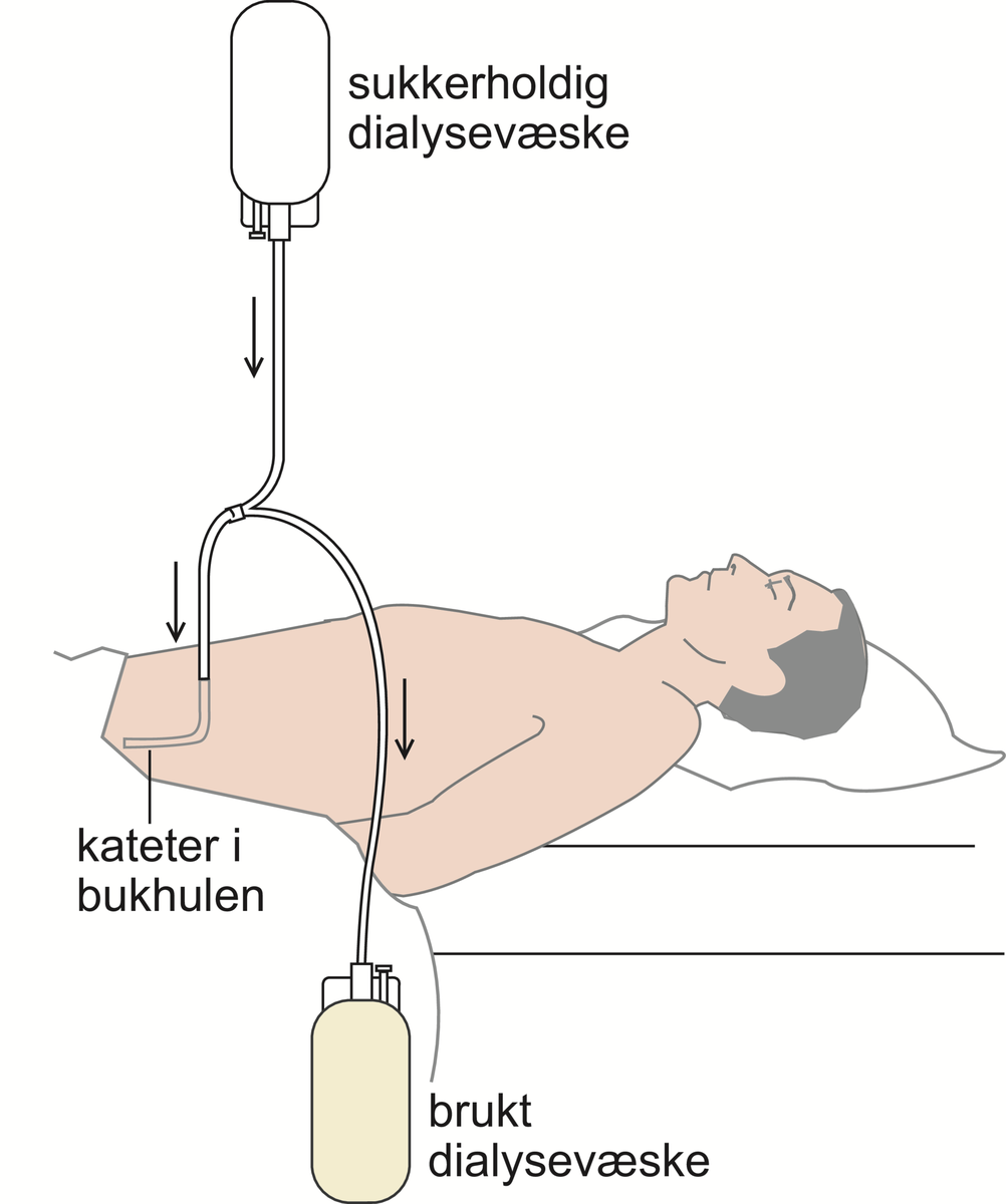 dialysebehandling