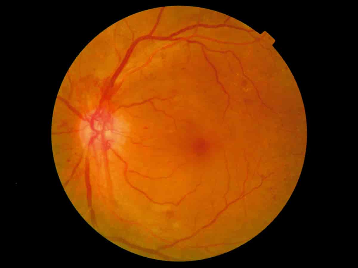 Proliferativ diabetisk retinopati