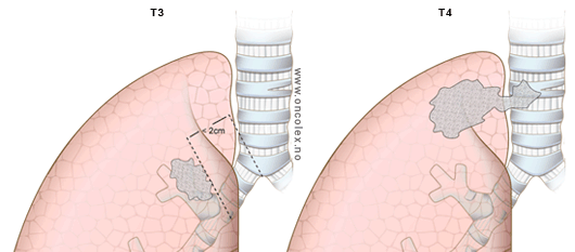 Lungekreft stadier