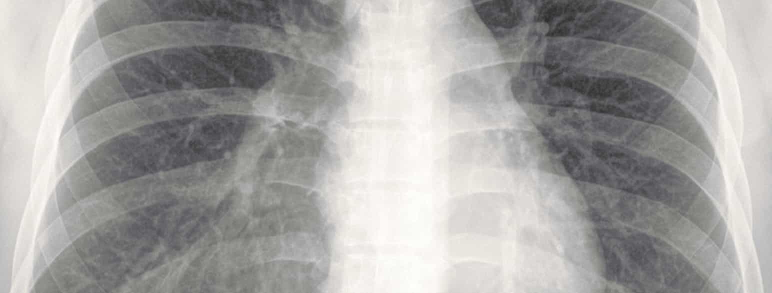 Røntgen thorax