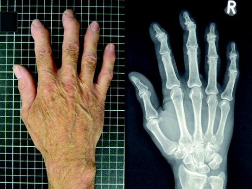 Artrose i hånd
