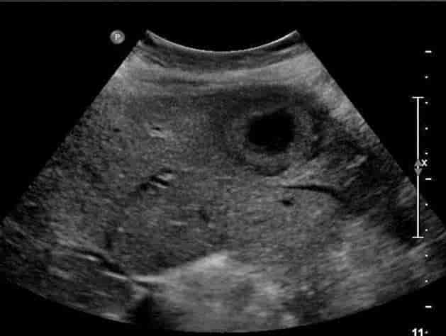 Ultralyd undersøkelse av leveren til kvinne i 50-årene viser et avvikende rundaktig område i venstre leverlapp som kan ligne en abscess (byll).