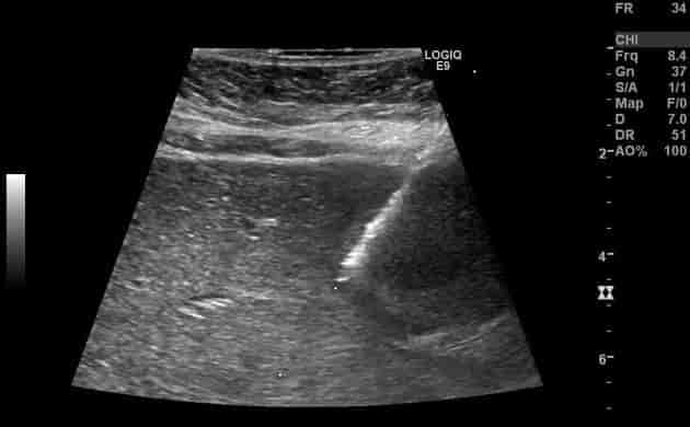 Ultralydveiledet finnåls biopsi avslørte at dette ikke var abscess men spredning til leveren fra en ondartet svulst.