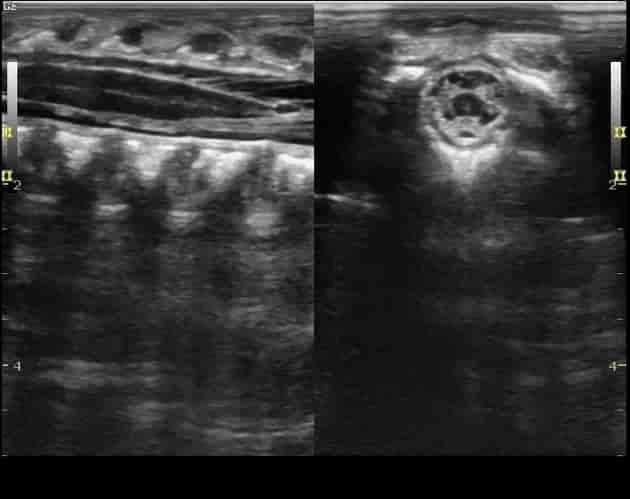 Ultralyd av ryggen hos et 20 dager gammelt barn. Normal fremstilling av nedre del av ryggmargkanalen med ryggmargen som avsluttes i en spiss (til venstre). Tverrsnitt av nerverøttene på bildet til høyre.