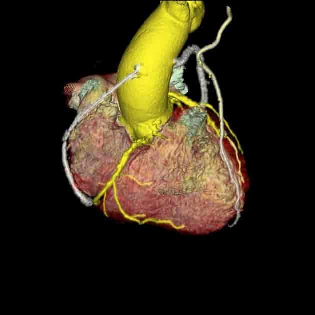 3D-rekonstruert CT kontroll etter hjerteoperasjon. Undersøkelsen viser at hjertets kransårer (gult) og kartransplantater fortsatt er åpne.