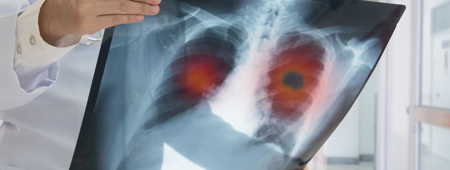 Røntgenbilde av lungekreft
