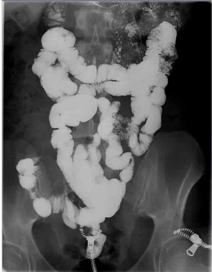 Røntgenbilde av normal tynntarm etter at pasienten har drukket bariumkontrast. (Glidelåsene av metall, som sees nederst i bildet, sitter naturligvis  i klærne).