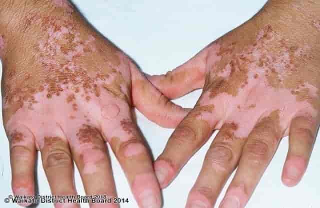 Vitiligo på håndrygg