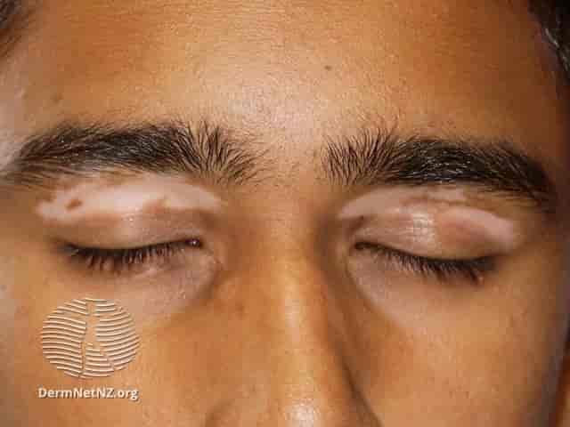 Vitiligo på øyelokk