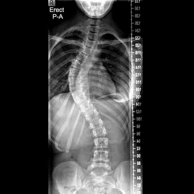 Røntgenbilde av en ung person med skjev rygg.