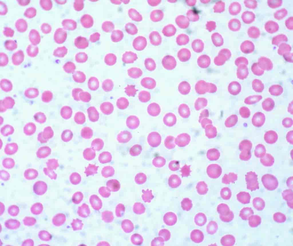 Normale røde blodceller og acanthocytter i lysmikroskop.